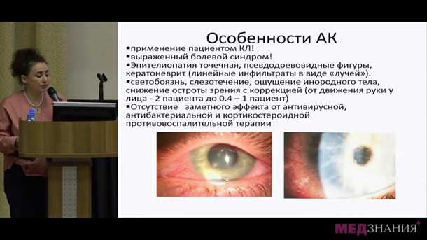 1. Ношение контактных линз