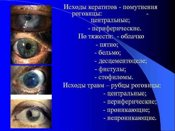 Гигиена контактных линз