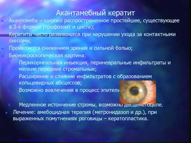 Акантамебный кератит, причины, симптомы, лечение кератита