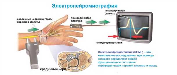 Принцип работы и важность электромиографии