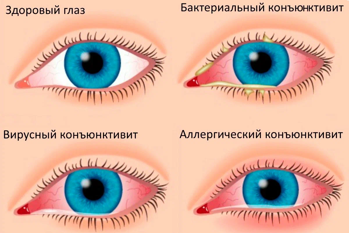 Лечение амблиопии