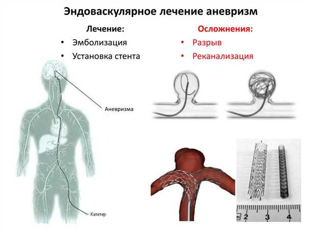 Альтернативные методы лечения аневризмы: эндоваскулярная терапия