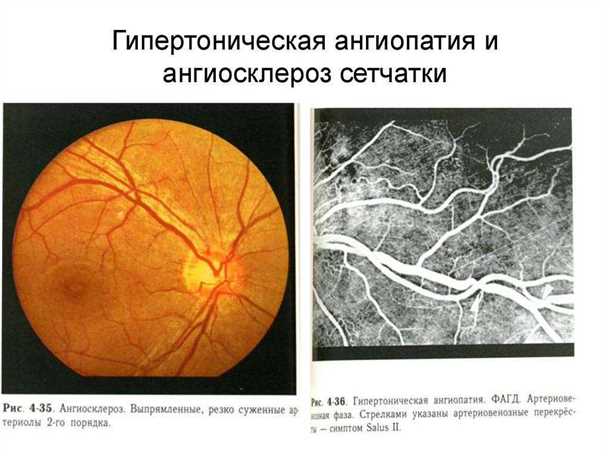 Прогрессирование ангиопатии