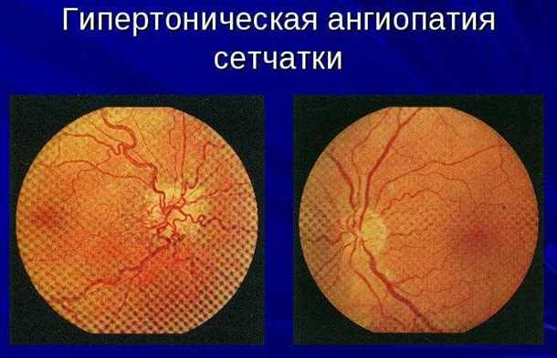 Основные методы лечения ангиопатии сетчатки при гипертонии: