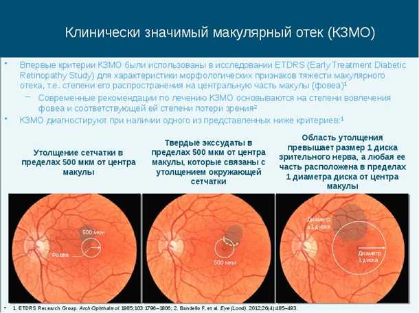 Анти- терапия — «золотой стандарт» лечения при диабетическом макулярном отёке