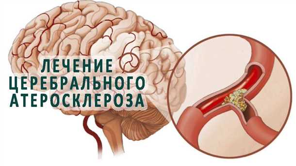 Влияние образа жизни и реабилитация на здоровье после инфаркта головного органа при системных заболеваниях сердца