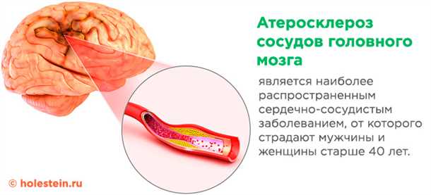 Атеросклероз сосудов головного мозга: методы профилактики и лечения.