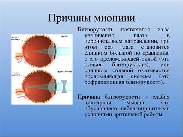 Близорукость (миопия), узнайте что такое близорукость