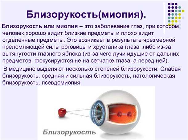 Развитие высокой степени близорукости