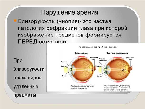 1. Что вызывает близорукость?