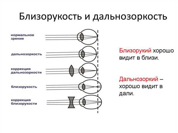 Методы лечения близорукости