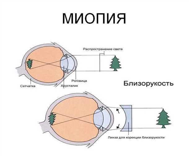 Как предотвратить развитие близорукости?