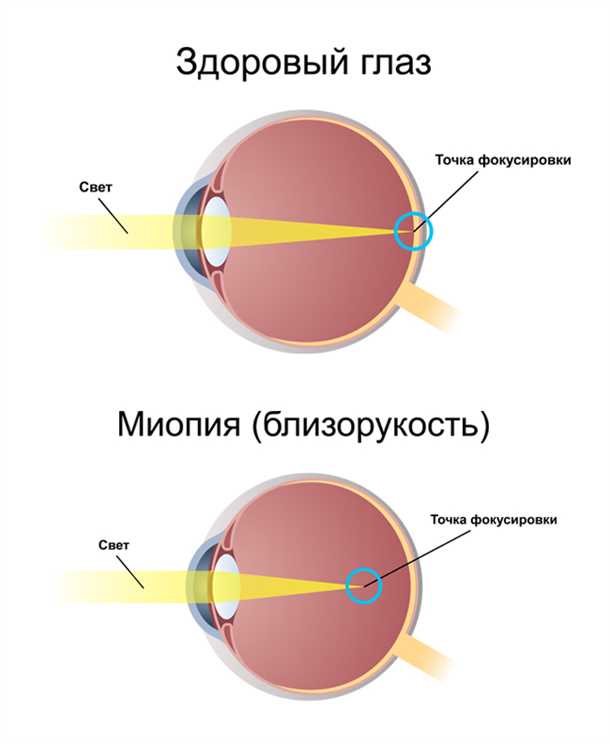 Близорукость (миопия), узнайте что такое близорукость