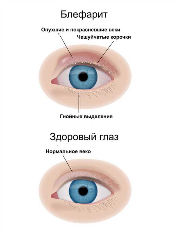 Боли в уголках глаз при контактных линзах