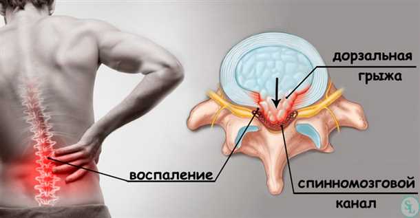 Методы выявления и обнаружения межпозвонковых грыж