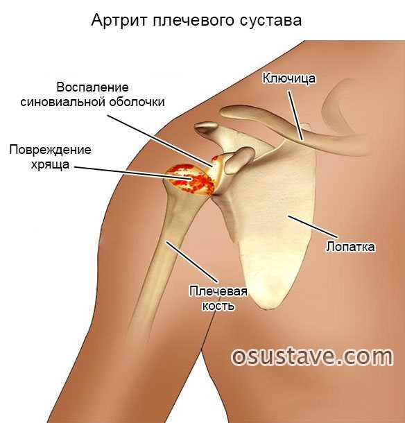 Болевые ощущения при остеоартрите и артрите плечевых суставов: методы облегчения.