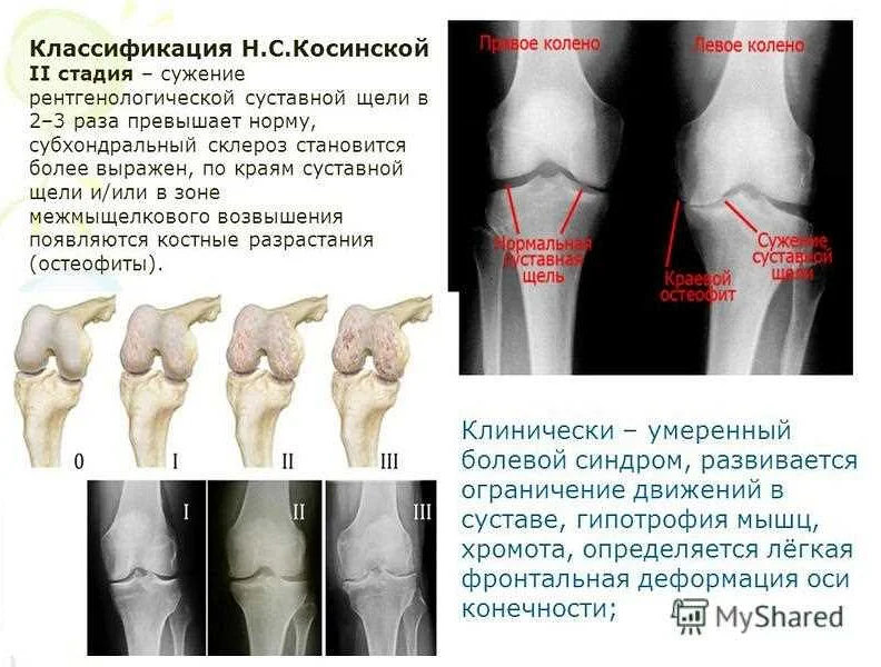 Диагностика остеоартроза коленного сустава: методы определения заболевания