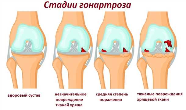 Боль и ее влияние на качество жизни при остеоартрозе коленного сустава