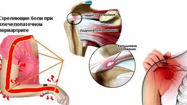 Современные методы выявления плечелопаточного периартрита