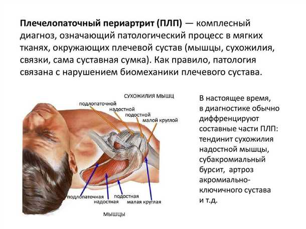 Альтернативные методы лечения плечелопаточного периартрита