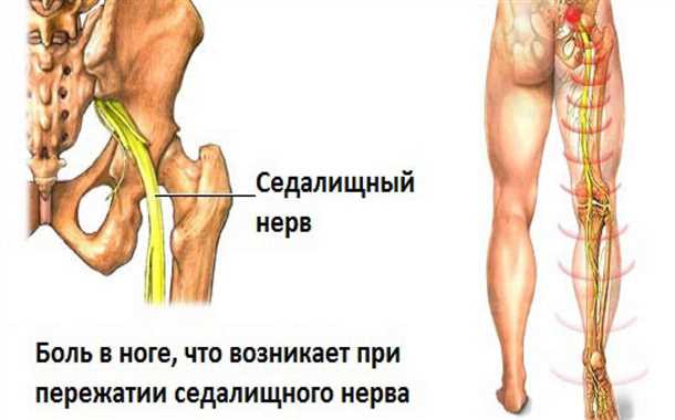 Причины развития воспаления седалищного нерва