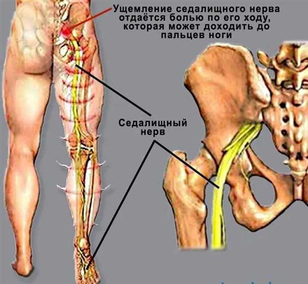 Болевые ощущения при воспалении седалищного нерва: методы диагностики и лечения.