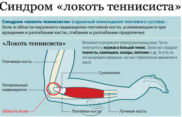 Различия в природе боли при воспалениях мышц и сухожилий