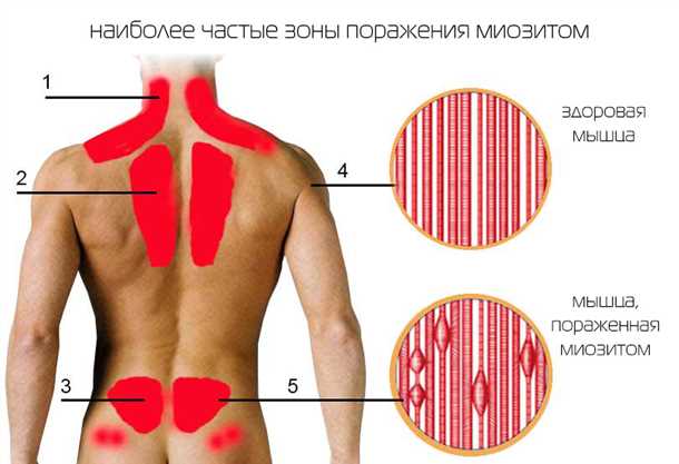 Болевые ощущения при воспалительных процессах мышц и сухожилий: диагностика и реабилитация.