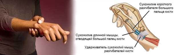 Главные признаки воспаления сухожилий