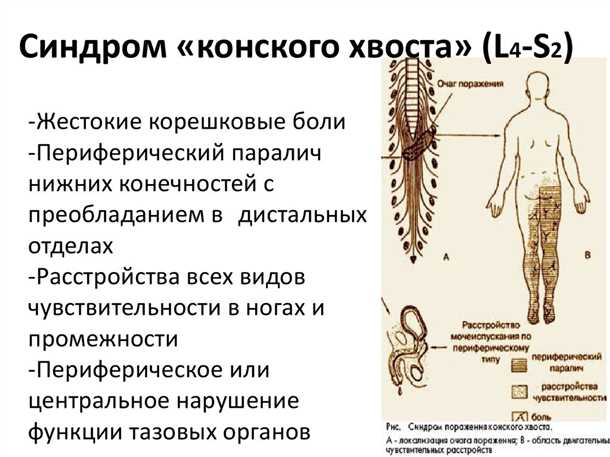Болевой синдром при позвоночных грыжах: симптомы и методы облегчения.