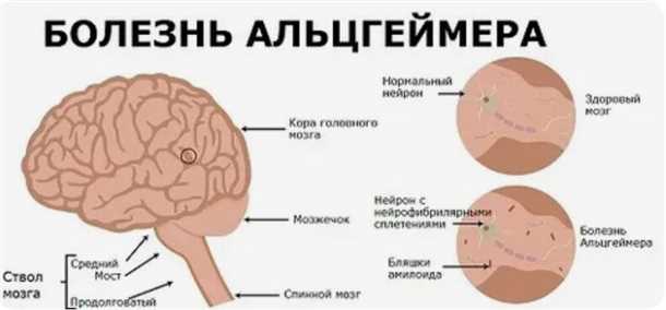 Факторы риска развития болезни Альцгеймера: влияние генетики и образа жизни