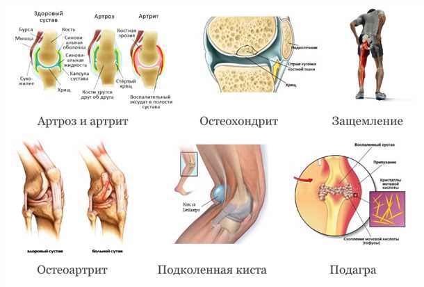 Боли в области коленного сустава: причины и методы облегчения.