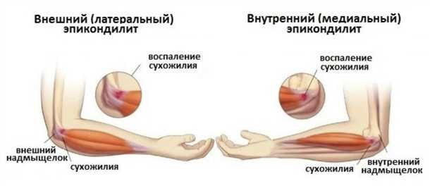  Симптомы теннисного локтя 