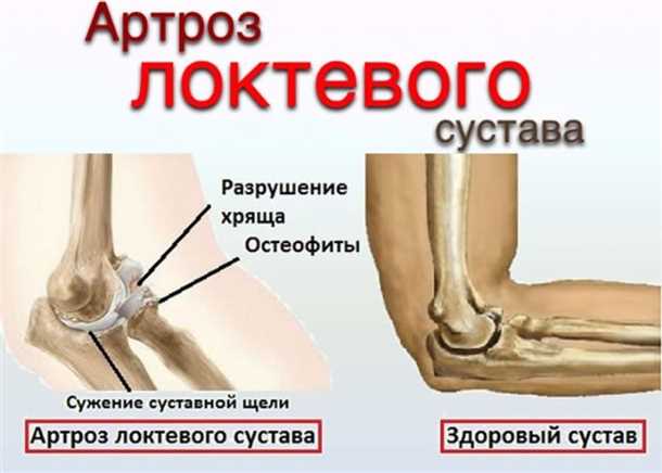 Ушибы и переломы: причины неприятных ощущений в локтевом суставе