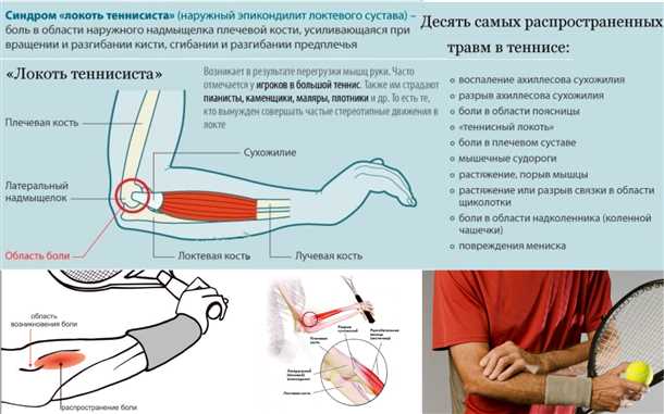  Теннисный локоть: симптомы и способы лечения 
