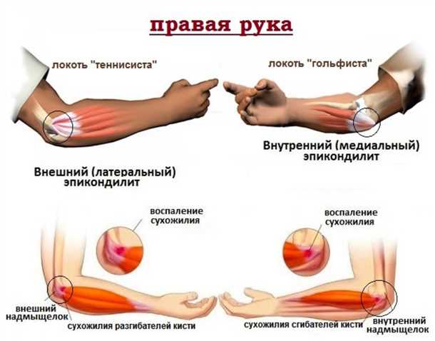Ушибы локтевого сочленения