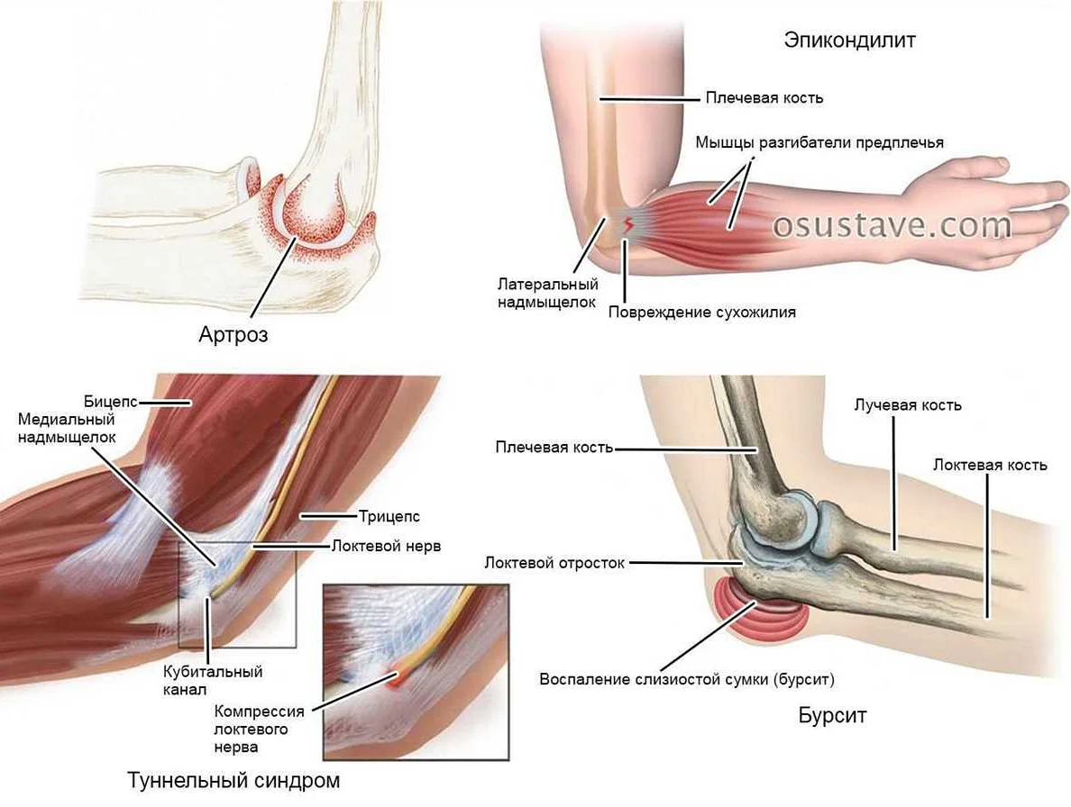 Боли в области локтя и запястья - основные причины дискомфорта и эффективные способы облегчения Боли в области локтя и запястья: причины и методы облегчения.