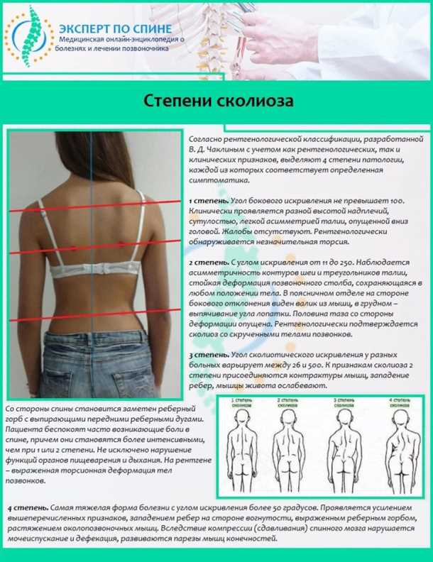 Боли в области позвоночника при сколиозе: диагностика и лечение.