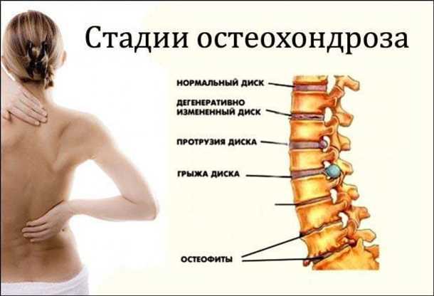Влияние неправильной осанки на мышцы шеи и позвоночник
