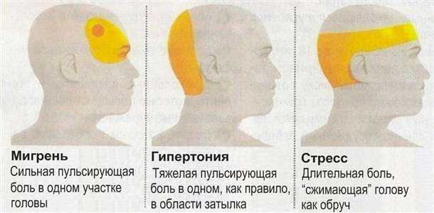 Источники мигрени