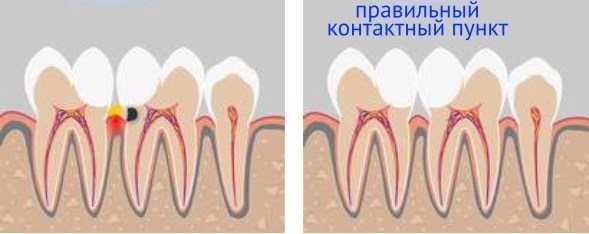 Синдром Сёгрена
