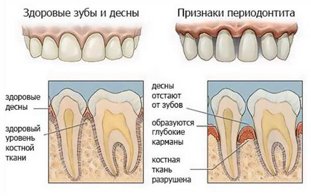 Болит десна между зубами