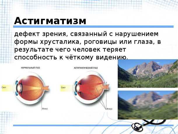 Что такое астигматизм, виды и степени астигматизма | Медицинская ...