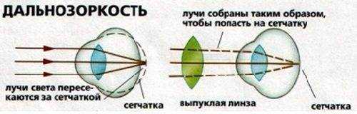 Как диагностировать дальнозоркость?