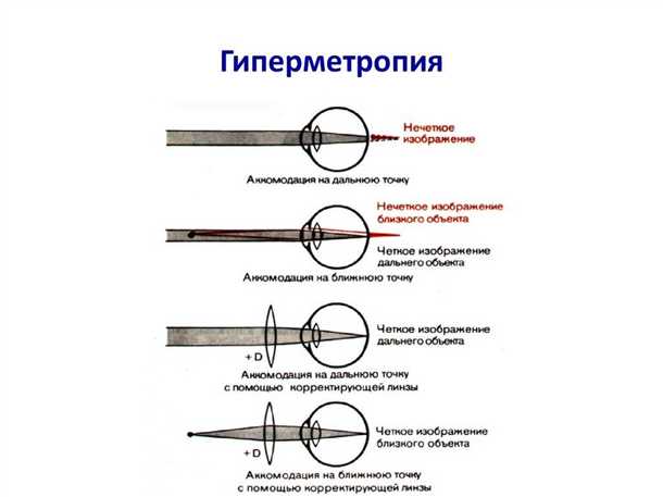 Степени дальнозоркости: легкая, умеренная, высокая