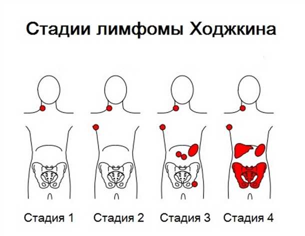 Различные виды лимфомы
