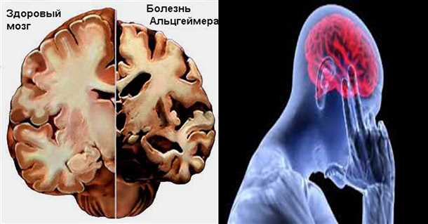 Нарушение работы гиппокампа – центра памяти и когнитивных функций