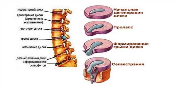 Дегенеративные изменения позвоночника: причины и лечение.
