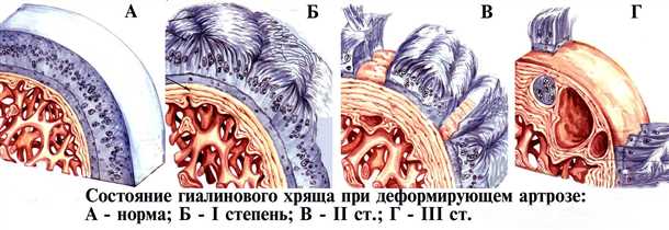 Медикаментозное лечение патологических изменений в хрящах