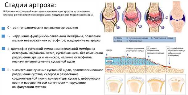 Предотвращение развития дегенерации хрящевой ткани: важность профилактики